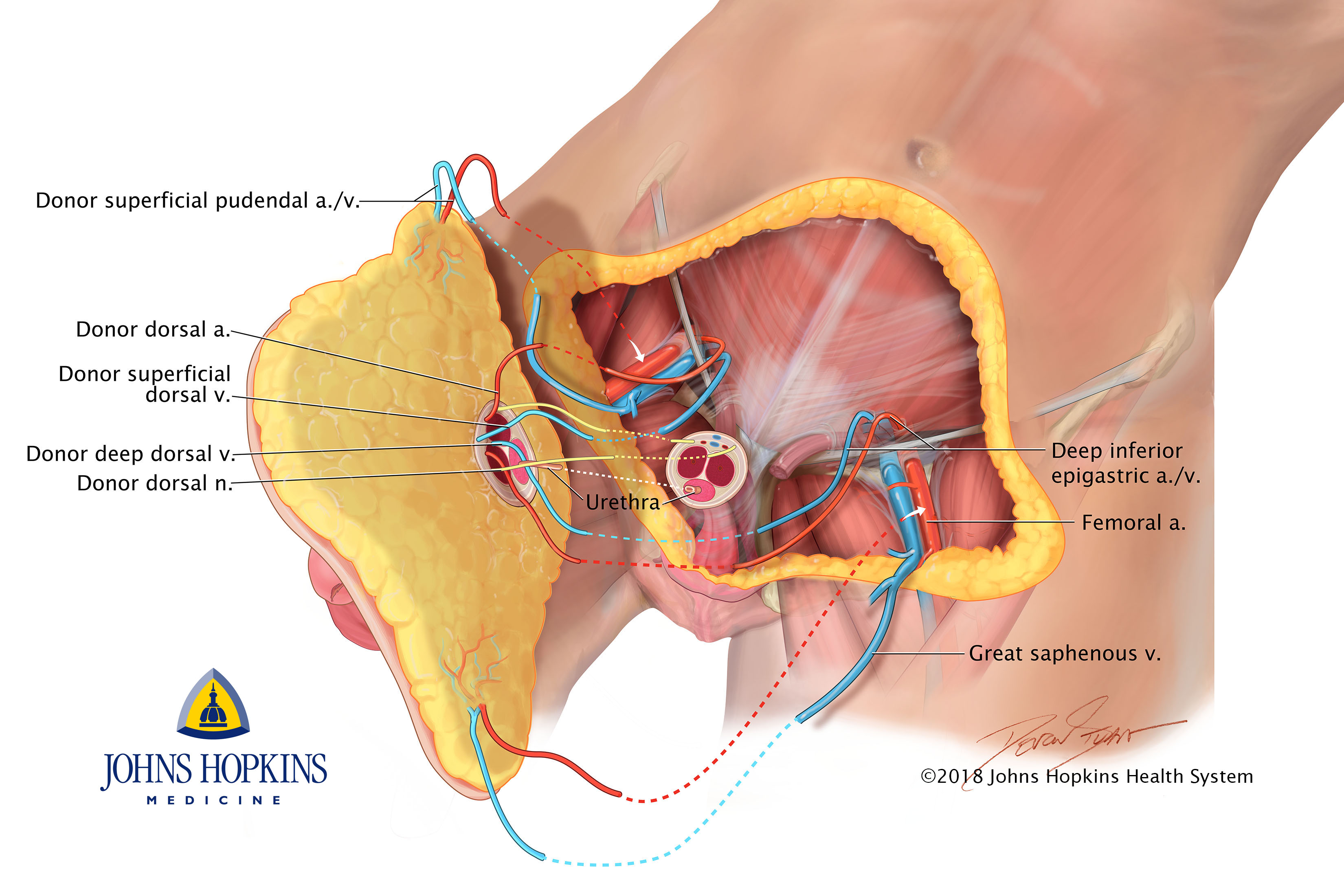 Johns Hopkins surgeons perform world s first total penis and